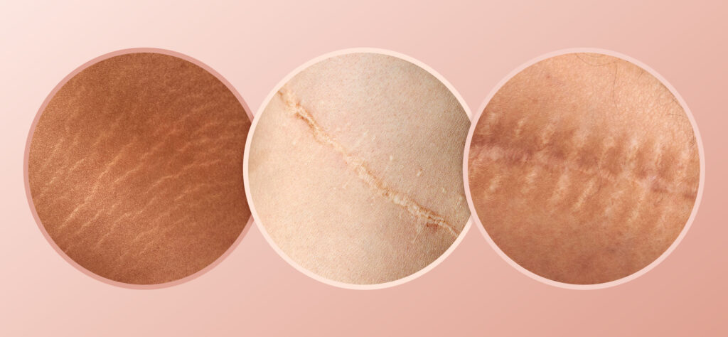 How Skin Camouflage and Medical Tattooing Restore Confidence After Scars